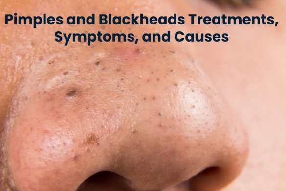 Pimples and Blackheads Treatments, Symptoms, and Causes
