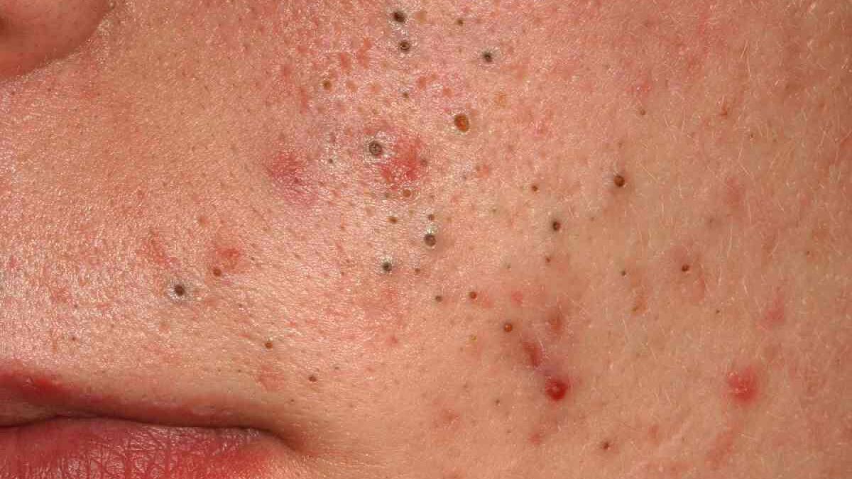 Pimples and Blackheads Treatments, Symptoms, and Causes