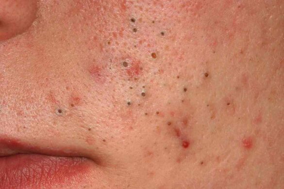 Pimples and Blackheads