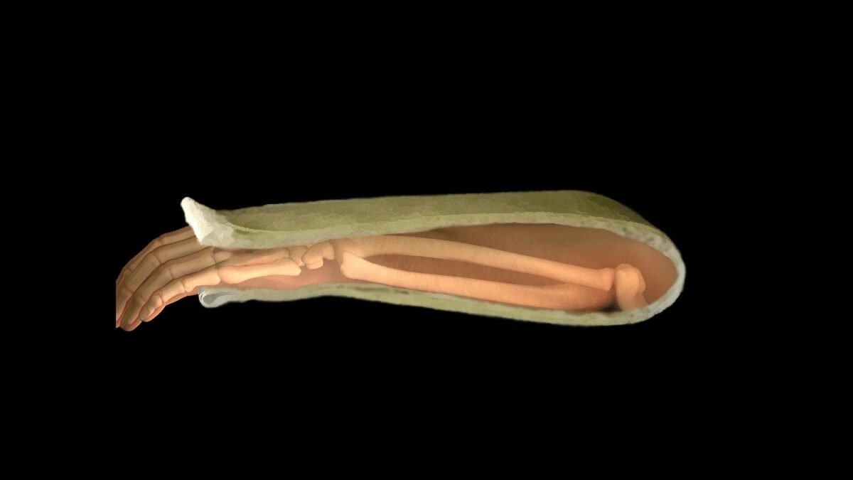 Sugar Tong Splint