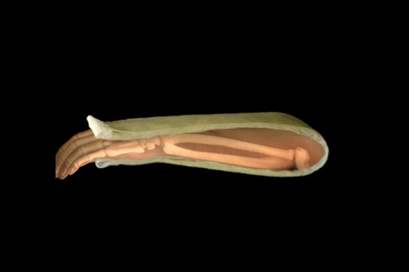 Sugar Tong Splint