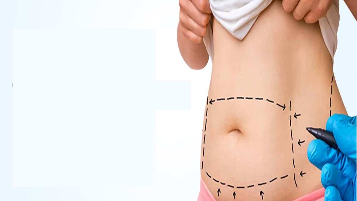 Tummy Tuck May Be A Great Option