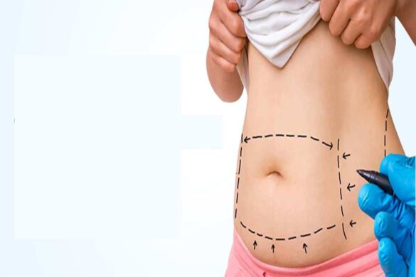 Tummy Tuck May Be A Great Option - 2022
