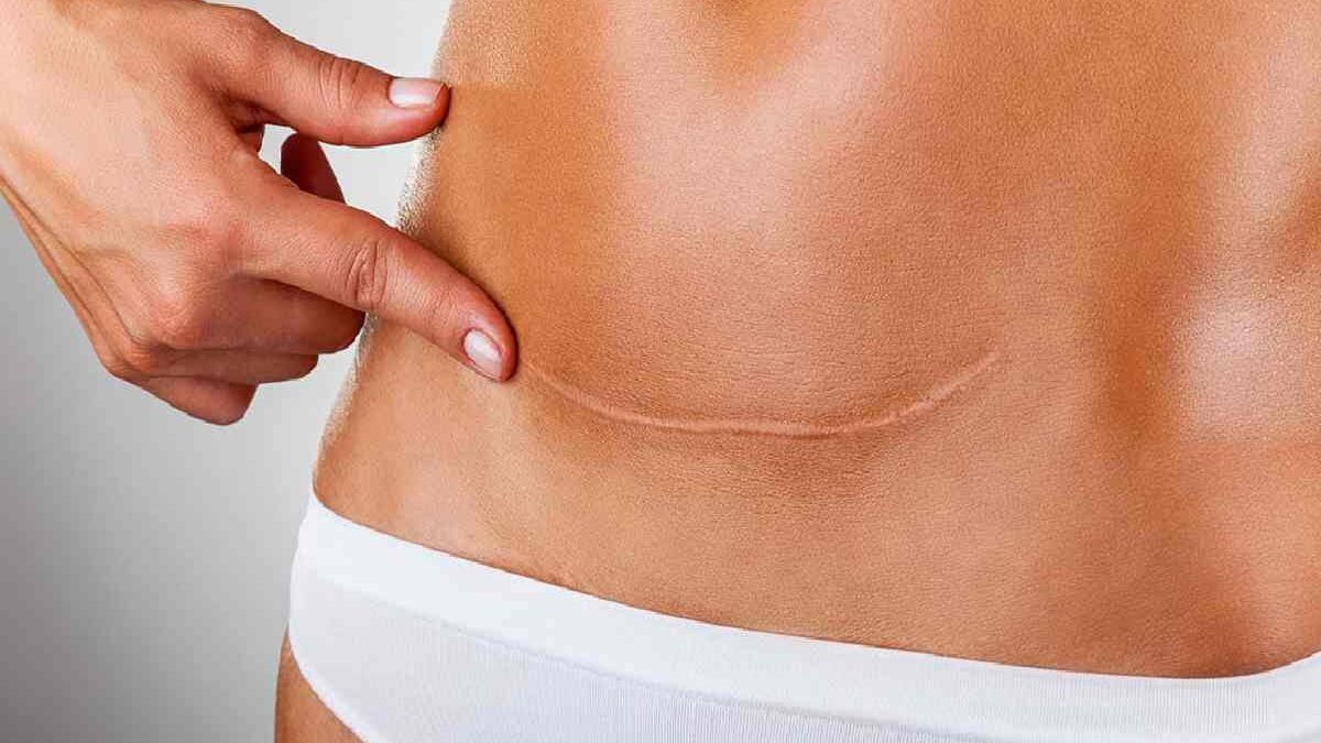 How to maintain your Tummy Tuck