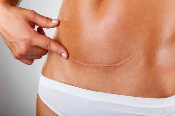 How to Maintain your Tummy Tuck - Techies Express - 2022